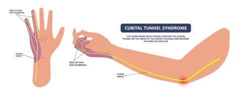 The Top 5 Symptoms Of Ulnar Nerve Damage What To Watch For