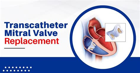 Transcatheter Mitral Replacement Tmvr Healingvalves