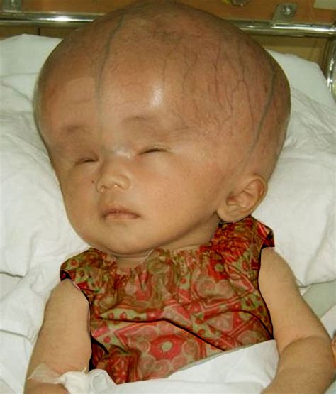Collection 93 Pictures Pictures Of Hydrocephalus In Adults Completed