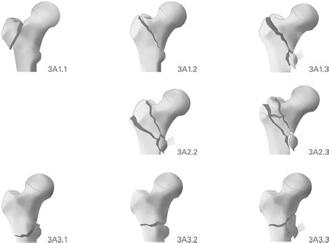 The New AO Classification System For Intertrochanteric Fractures Allows Better Agreement Than