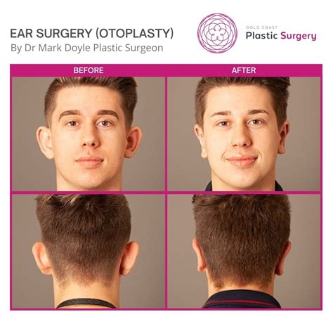 Otoplasty Before After