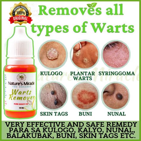 warts remover original 100 organic kasoy oil very effective for warts skin tags moles genital