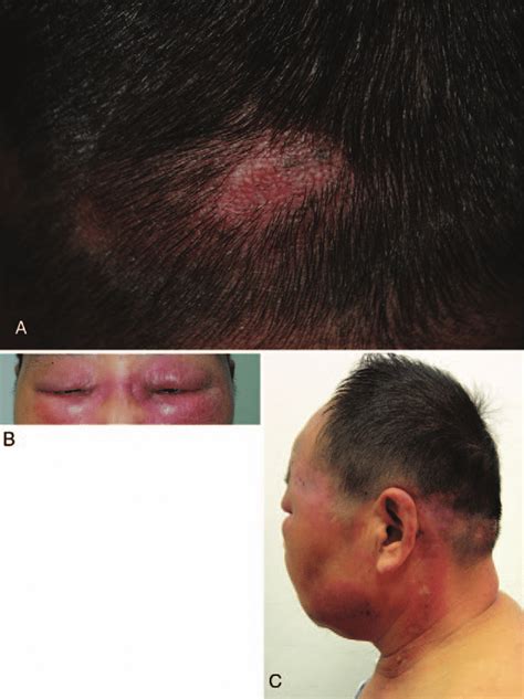 A Indurate Hairless Macule On The Left Occipital Scalp B Swelling