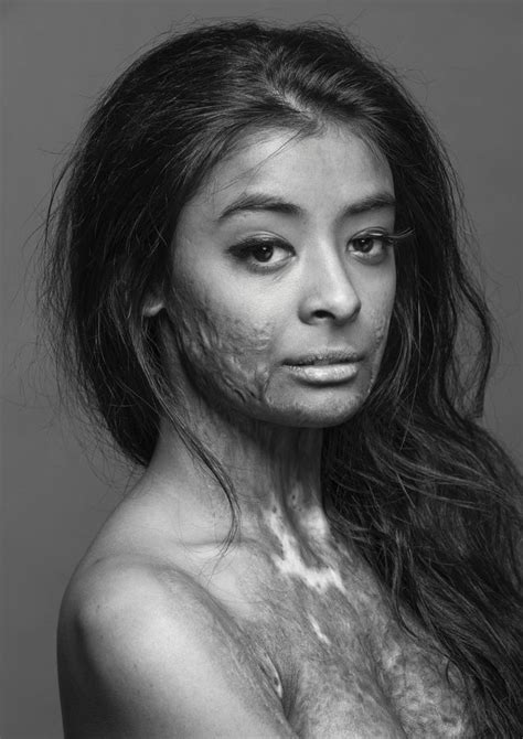 Pin By Thiago Correia On Portrait Burn Survivor Beautiful Models Beautiful