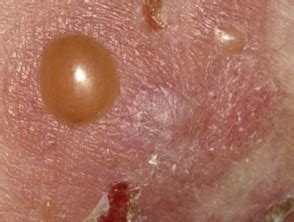 Bullous Pemphigoid Skin Disease