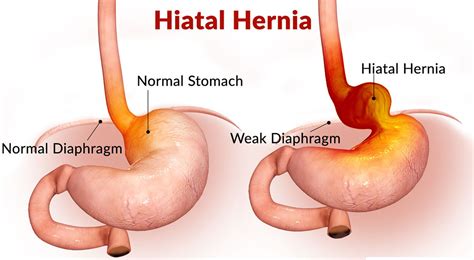 Hiatal Hernia Causes Symptoms Diagnosis Treatment And Surgery