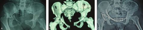 (A) This photo indicated fractures of left iliac wing ...