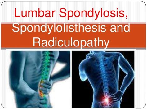 Lumbar Spondylosis Spondylolisthesis And Radiculopathy