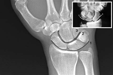 Dislocation Wrist Lunate Hand Surgery Resource