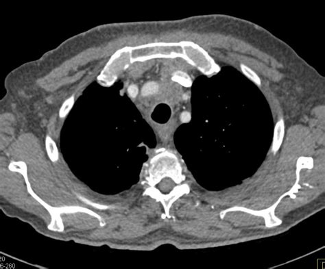 Lymphoma With Extensive Adenopathy And Encasement Of The Pulmonary