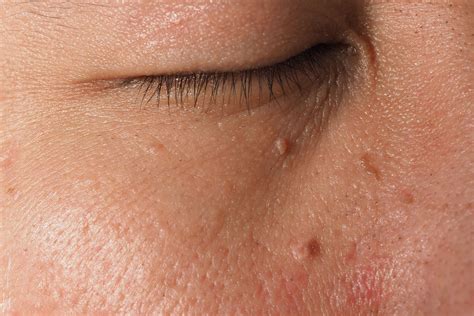 Armazenamento Mistura Brilhar Raised Skin Bumps On Face Construção