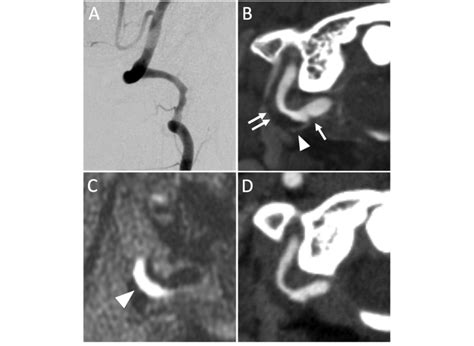 Imagings Showing The Right Vertebral Artery Dissection In The V3