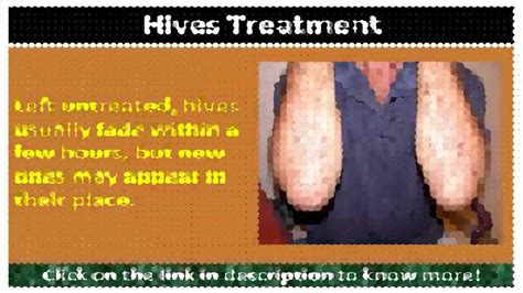 Hives Medical Treatment Youtube