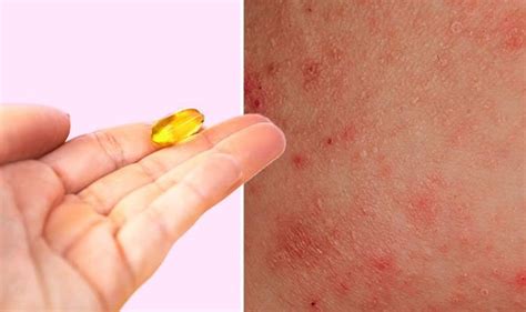 Eczema Treatment Atopic Eczema Symptoms Includes Taking Vitamin D