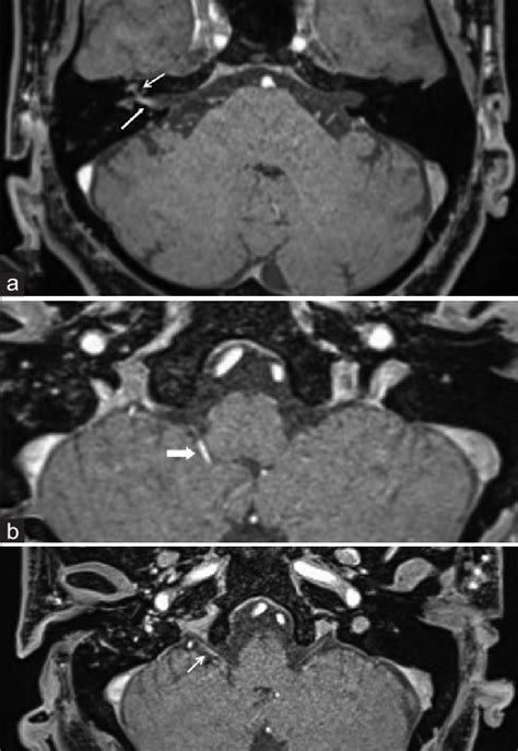 Post Contrast 3d T1 Weighted Image Of Iac Mri In A Patient With Ramsay