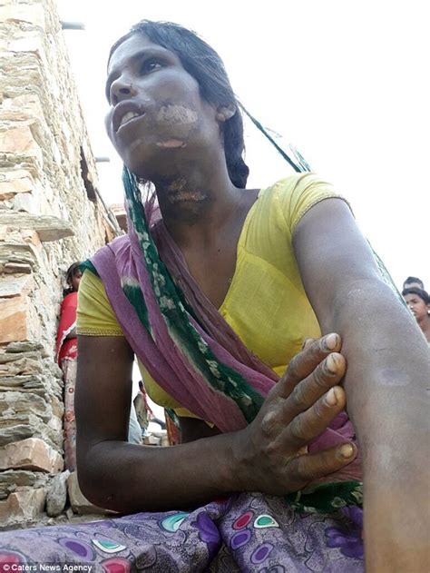 Indian Woman Horrifically Branded With Hot Tongs Daily Mail Online