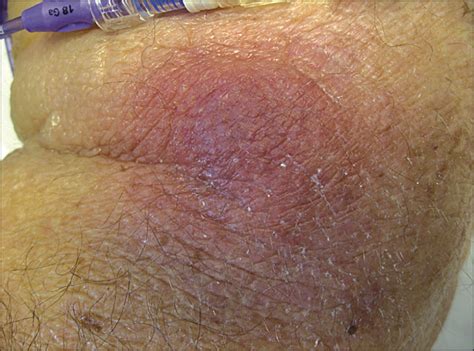 Edematous Nodules On The Extremities Of A Febrile Patient—quiz Case