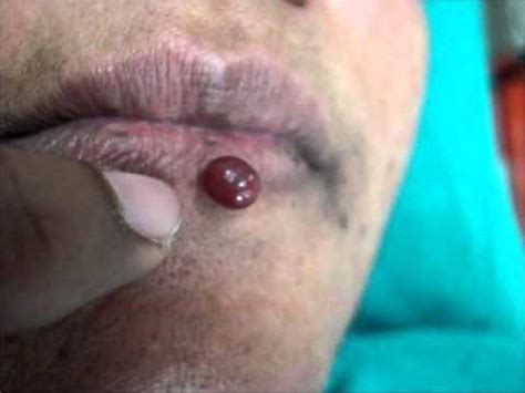 Cherry angioma is a type of tumor or cyst that attacks people above 40 and is marked by the presence of lesions or red color. Hemangioma Lower Lip. - YouTube