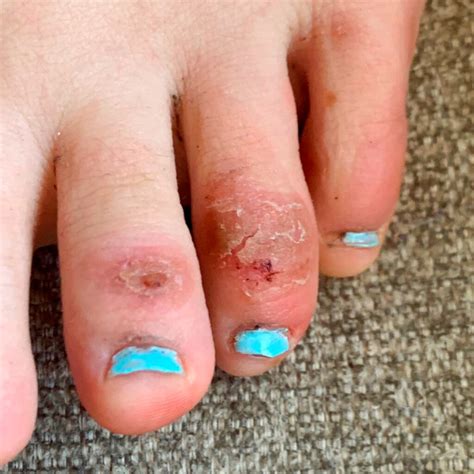 ‘covid Toes Other Rashes Latest Possible Rare Coronavirus Signs