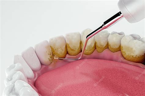 Clinica Jin Descubra Os Benefícios Das Lentes De Contato Dentais Para