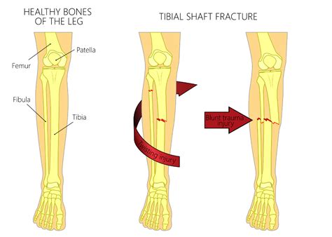 Tibia Or Fibula Fractures Indiana Slip And Fall Lawyers