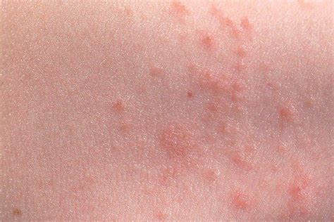 Rashes And Spots In Children With Pictures Page 9