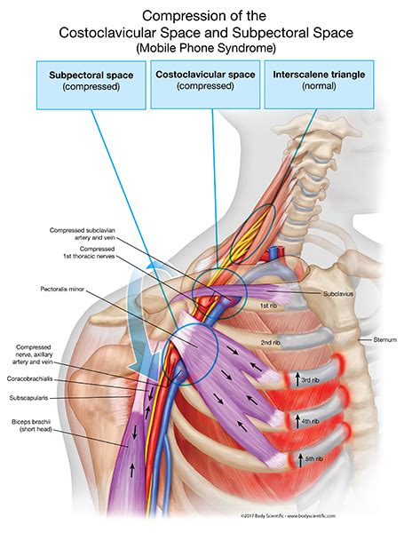 Thoracic Outlet Syndrome Rib Resection Recovery Stories