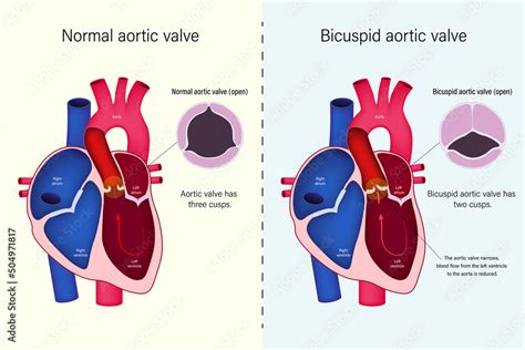 The Difference Of Normal Heart Valve And Bicuspid Aortic Valve Vector Congenital Heart Disease