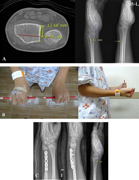 Corrective Osteotomy For Malunion Of Distal Diaphysealmetaphyseal