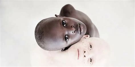 Incredible Images Of Tanzanias Albino Kids Who Survived Being Killed