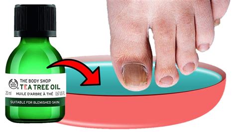 how to get rid of toenail fungus naturally with tea tree oil youtube