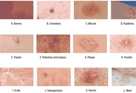 Image Gallery Skin Lesions