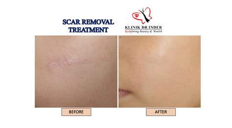 Laser Scar Removal Scar Removal Treatment Aesthetic Clinic