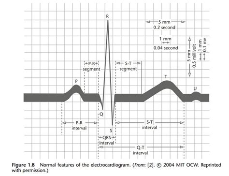 Normal Features Of The Electrocardiogram Ekg Interpretation Nursing