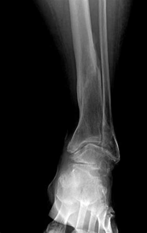 When A Patient Has An Equinovarus Contracture Secondary To A Neglected