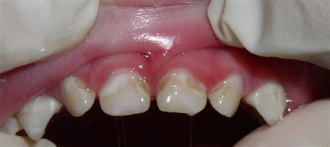 Black Stains On Teeth Near Gum Line Teethwalls