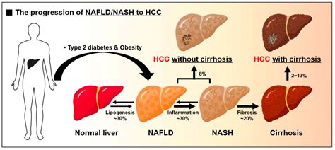Ijms Free Full Text Metabolic Spectrum Of Liver Failure In Type 2 Diabetes And Obesity From