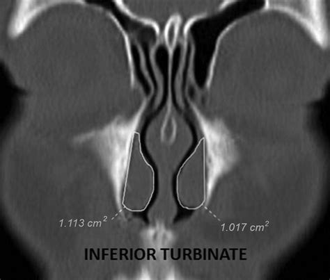 Coronal Computed Tomography Images Of The Inferior Turbinate Showing