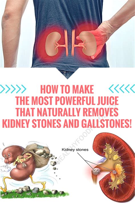Which Is More Painful Gallstones Or Kidney Stones