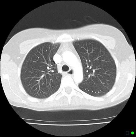 Normal Chest Ct Lung Window Radiology Case
