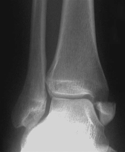 Conservative Treatment Of Isolated Fractures Of The Medial Malleolus