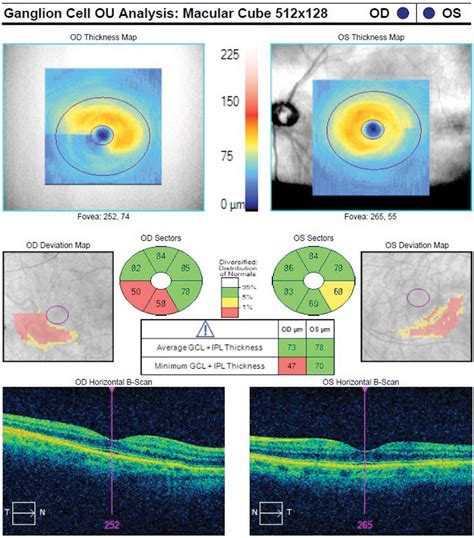 Lesson Maximizing Oct In The Diagnosis And Management Of Glaucoma