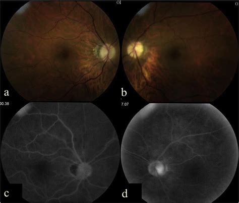 Fundus Photography Ab And Fundus Fluorescein Angiography Cd Two