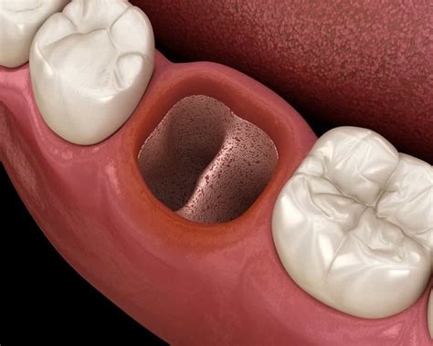 CirugÍa Bucal Alveolitis Dental Sepa Cómo Prevenirla Directorio Odontológico