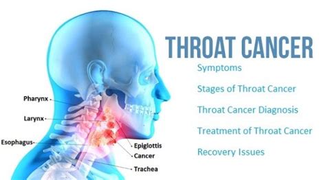 Anatomically, the throat is the muscular tube that runs initial symptoms of throat cancer. Throat Cancer Causes Symptoms and Effective Homeopathic ...