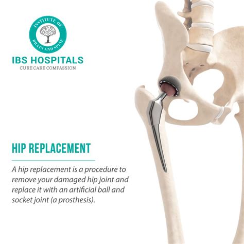 What Is A Hip Replacement Procedure A Hip Replacement Is A Procedure