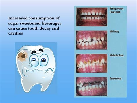 At Young At Heart Kids Dentistry We See Decay In Varying Degrees We
