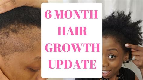 Natural Hair Hair Growth6 Month Hair Transplant Update Youtube