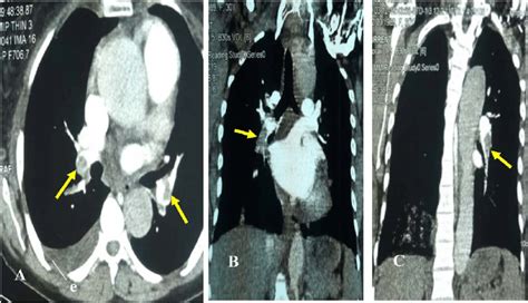Thoracic Ct Scan Showing Thrombi In Bilateral Lobar Arteries Yellow