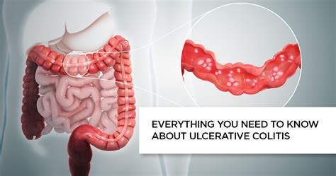 Ulcerative Colitis Symptoms Causes Lifestyle Changes And Treatment